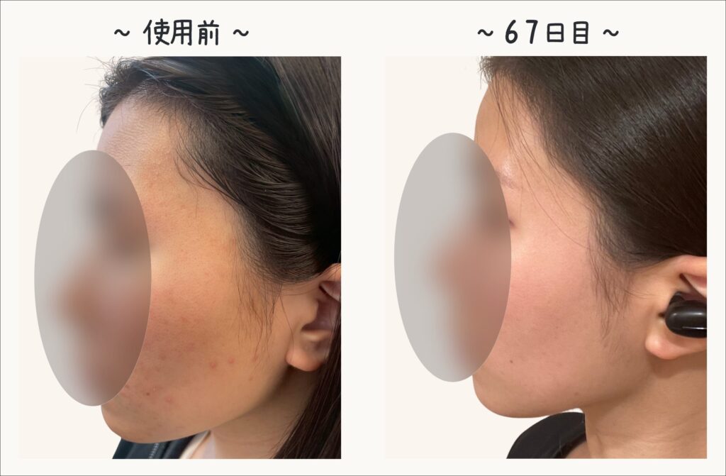 美顔器の使用前と67日目の肌状態を比較した女性の横顔写真。使用前の肌荒れや赤みが、67日目にはなめらかで健やかな肌へと変化している様子のビフォーアフター。