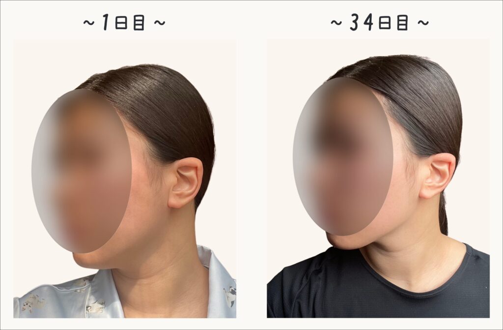 美顔器の使用1日目と34日目のフェイスラインを比較した女性の斜め後ろ姿の写真。継続使用によって顎ラインや首元がすっきりとした印象に変化している様子のビフォーアフター。